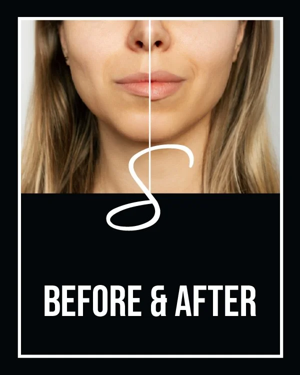 Close-up of a woman's face before and after a cosmetic procedure, showing improved skin texture. Text reads 'Before & After'.